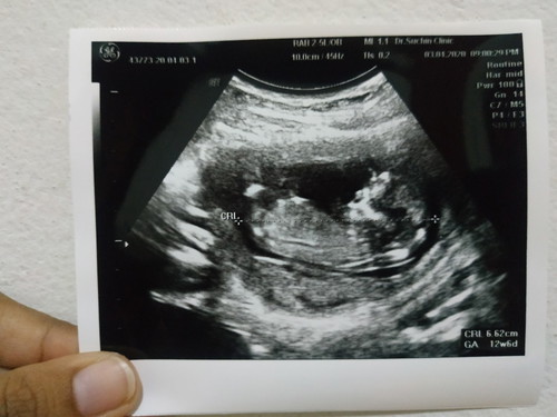 12 w 6 d หมอบอกรกเกาะต่ำกังวลคะ
