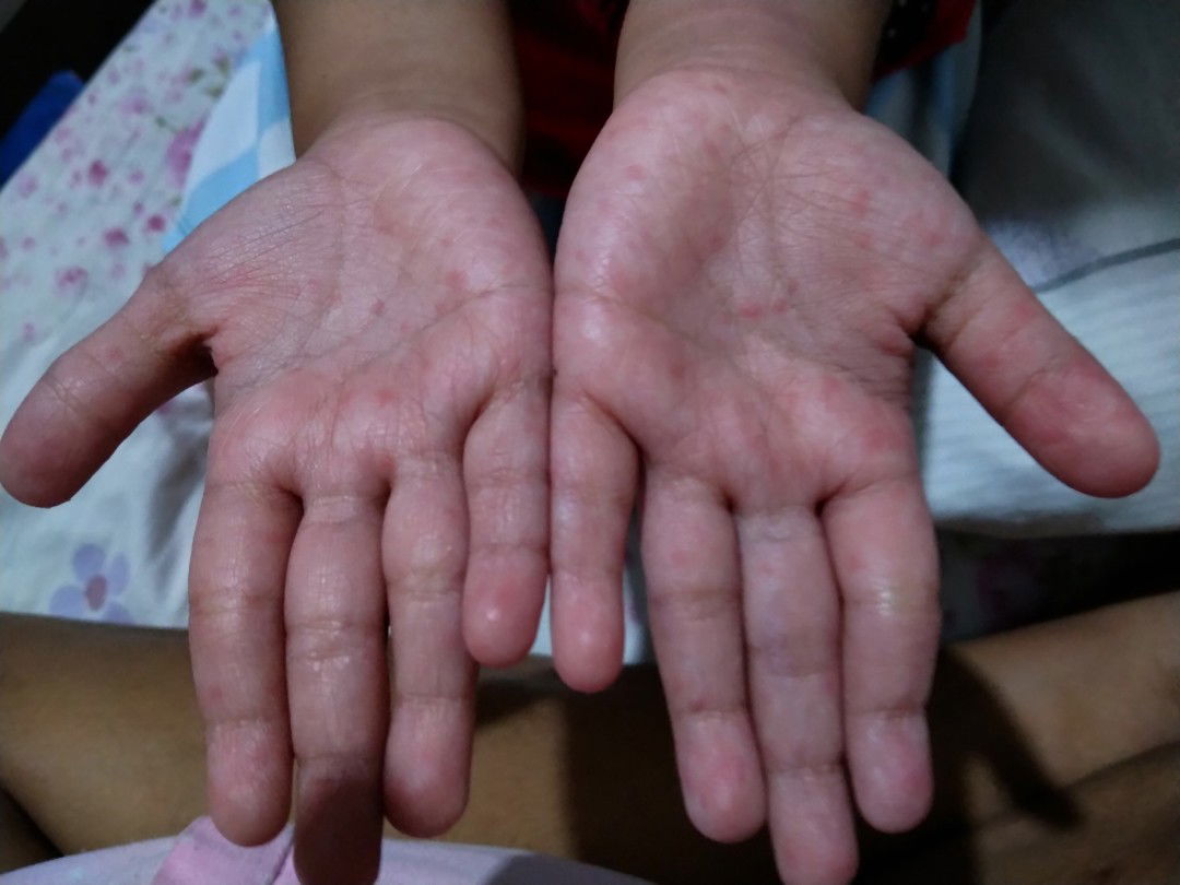 red spots on palms
