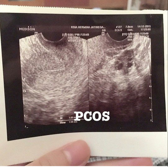 Sharing Promil Anak Pertama karena PCOS