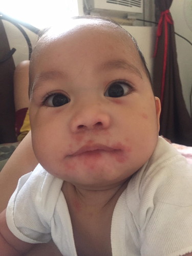 Mamaso (Skin disease)