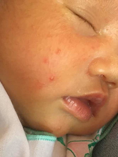 ผดบนหน้าลูก