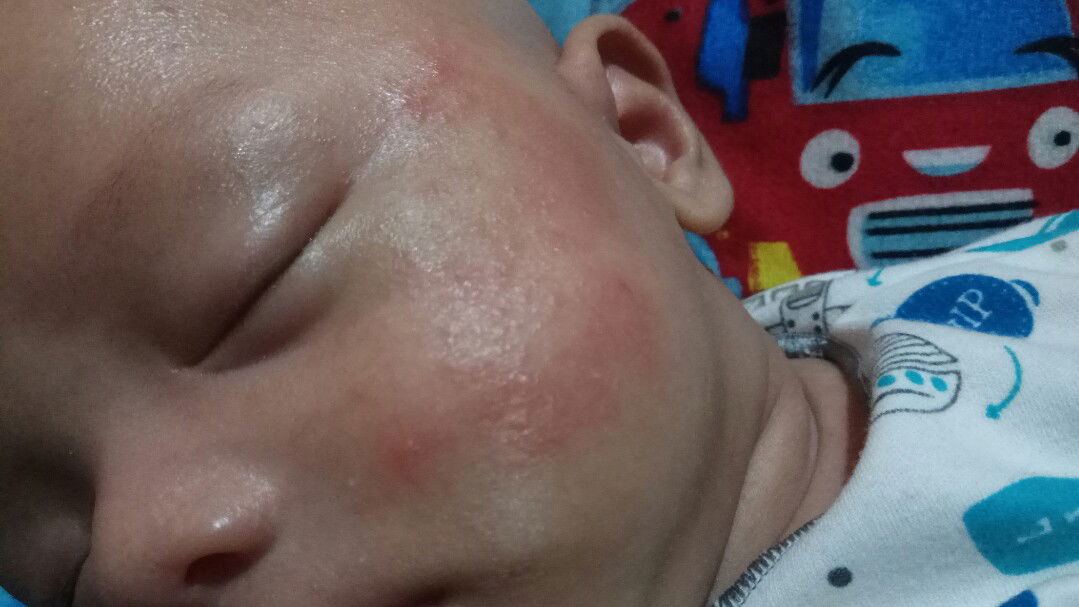 ruam merah2 di pipi bayi