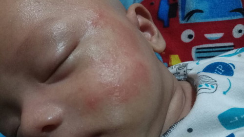 ruam merah2 di pipi bayi