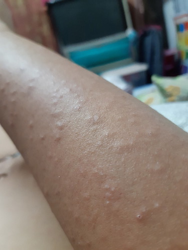sakin rashes?