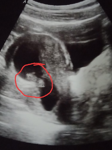 ตั้งครรภ์น้องได้ 3 เดือนกว่า