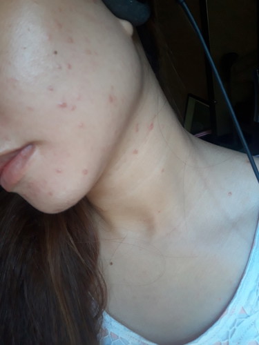 PIMPLES