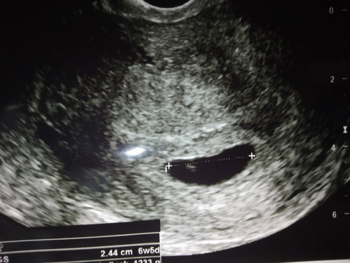 6w5d