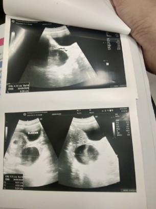 ท้องได้ 8 สัปดาห์ 2 วัน แต่มีถุงน้ำด้านซ้าย 6 เซนติเมตร