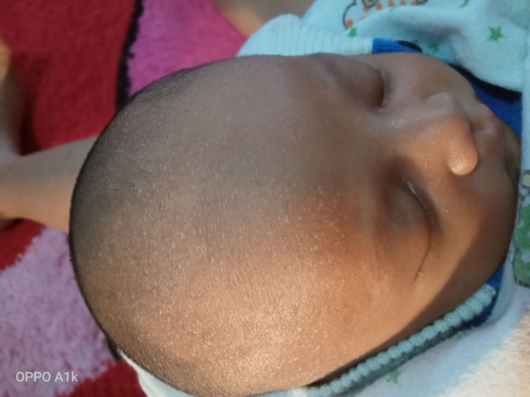 bruntusan di kepala bayi