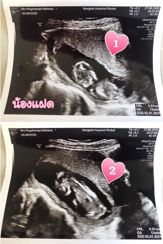 ท้องแฝด อยากรู้เพศน้องไวๆจังเลย