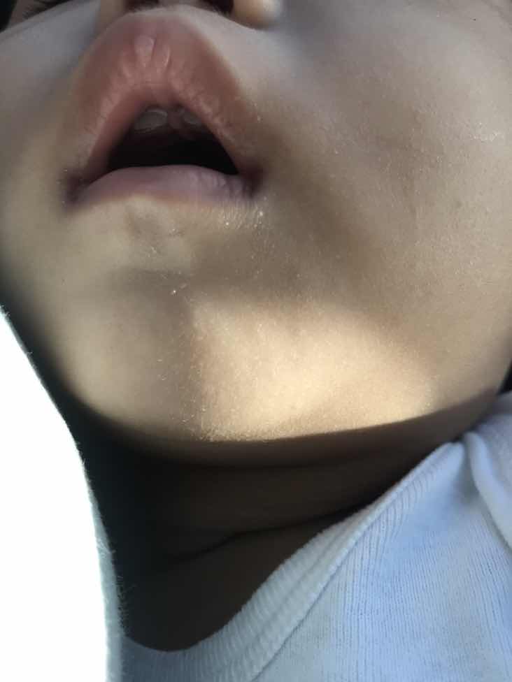 gano po kalayo pagitan ng dalawang ngipin sa itaas pag unang tubo kay baby? normal po ba na malayo ito sa isat isa?