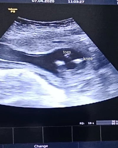 ยังไม่เห็นเพศลูก