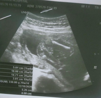 ตั้งครรภ์ได้ครึ่งทางแล้วจ้า20สัปดา