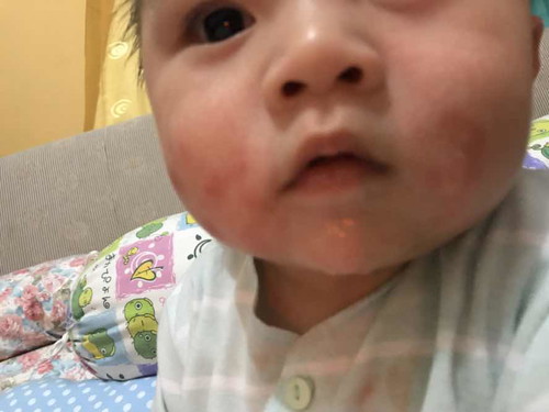 Dermatitis atopik