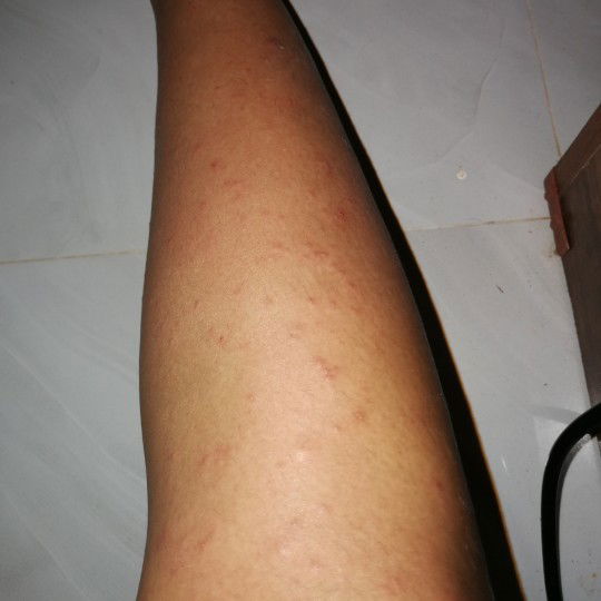 มีผื่นเต็มตัว