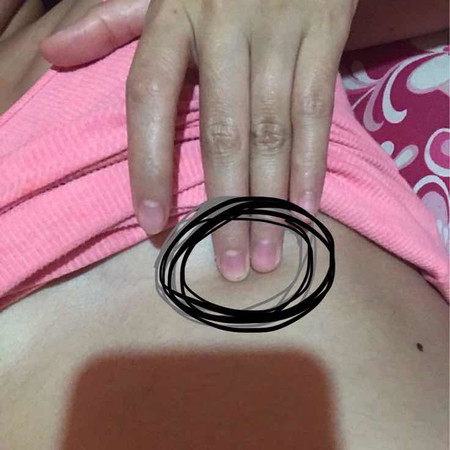 Momies bakit maskit sa ganito ko? Pag nkahiga or tatayo ako lage talaga nasakit banda sa may cirle . Mga 1 week kona naramdaman