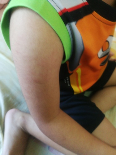 ลูกฉีดวัคซีนแร้วมีผื่น