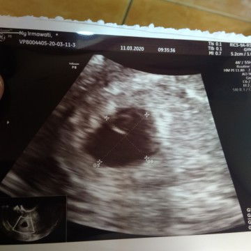 Bentuk Kantung Kehamilan