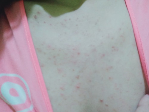 Pimples?