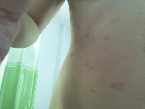 ท้อง 2 ผื่นขึ้นเต็ม แก้ยังไงได้บ้าง?