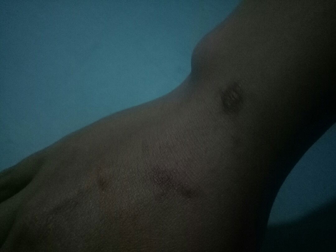 apakah mungkin alergi terhadap vitamin kehamilan?