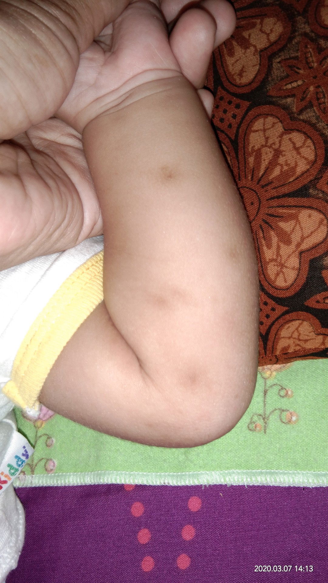 Bekas gigitan nyamuk