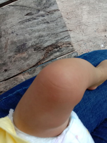 ลูกเป็นผื่นเต็มตัวไม่หายต้องทำยังไงดีคะ