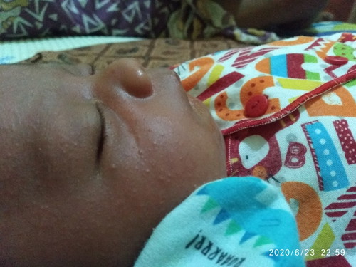 Bun anak saya d muka bruntusan kecil" memerah"an itu obatnya apa ya..kata mamah saya sih bruntusan itu karna ASI-nya kadang tumpah ke muka baby saya..