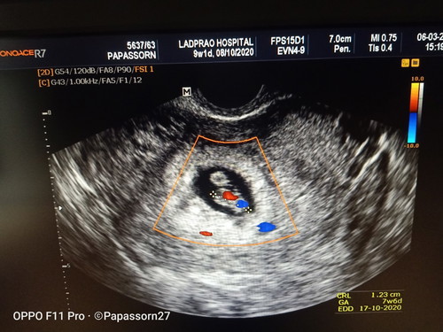 นับอายุครรภ์ ประจำเดือน9w1d เครื่องซาวด์7w6d ยึดตามอันไหนคะ