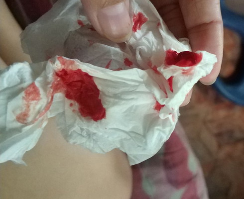 NOSEBLEED
