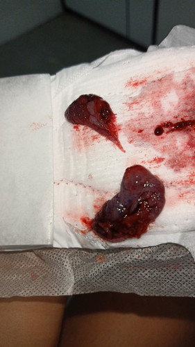 การสูญเสีย