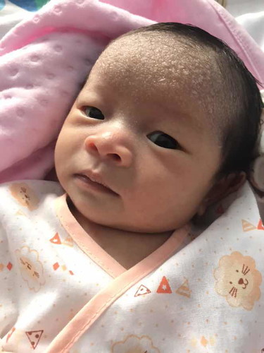 น้องโบนัสเหมือนมีผดใสๆขึ้นหน้าผากเต็มเลยคะ ตอนแรกเป็นเม็ดแดงๆเปลี่ยนเป็นใสๆ