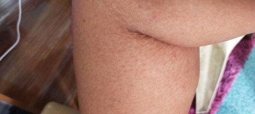Rashes