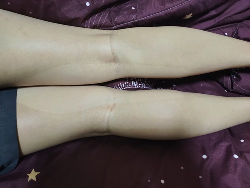 Pigmentation at back of legs