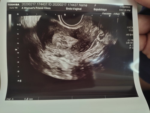 สอบถามหน่อยค่ะ เราประจำเดือนขาดประมาณ 3 วัน แล้วไปหาหมออัลตร้าซาวน์ คุณหมอบอกว่าท้องได้ประมาณ 3 weeks เจอถุงตั้งครรภ์ ขนาด 1 มิล แบบนี้ถือว่าเล็กไปไหมคะ