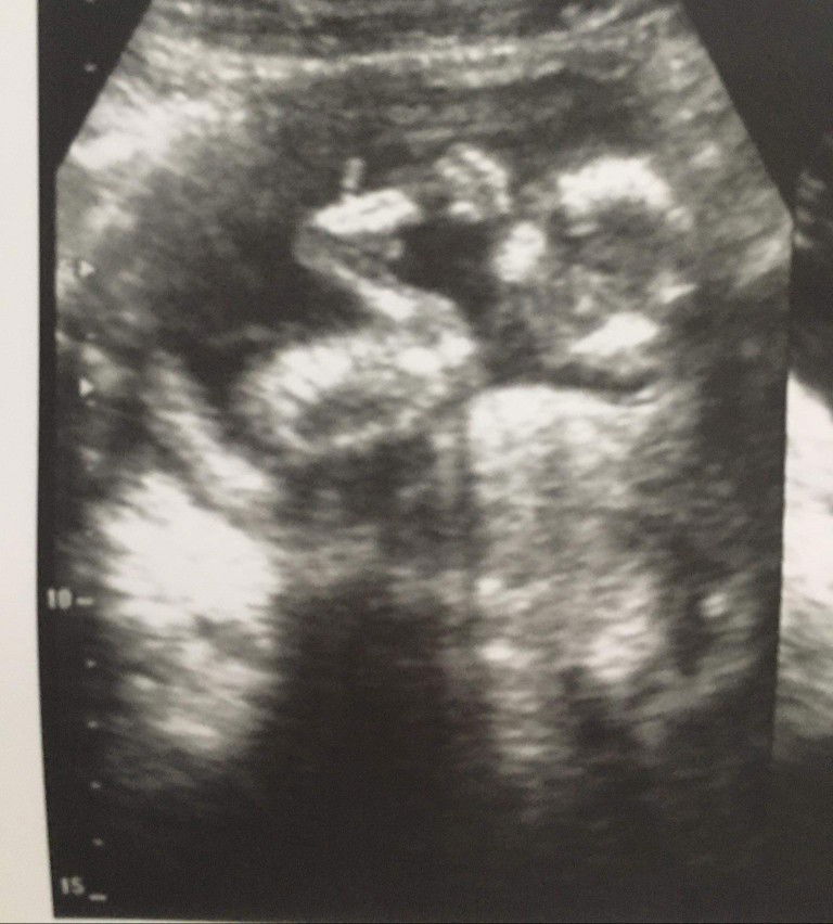14 weeks ultrasound thumb sucking