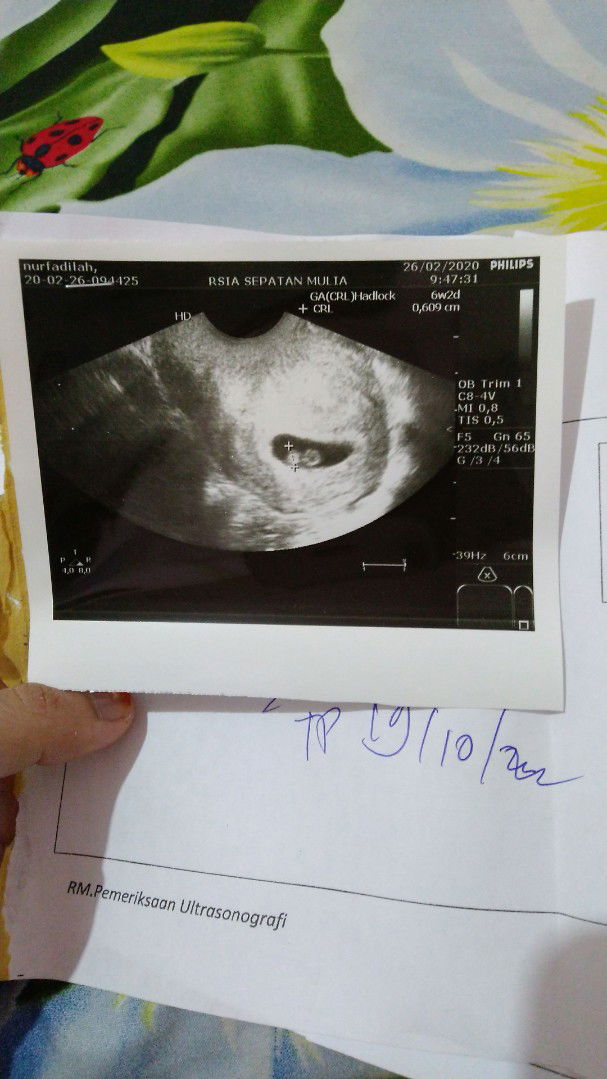 ini usg bayi kembar apa bukan?