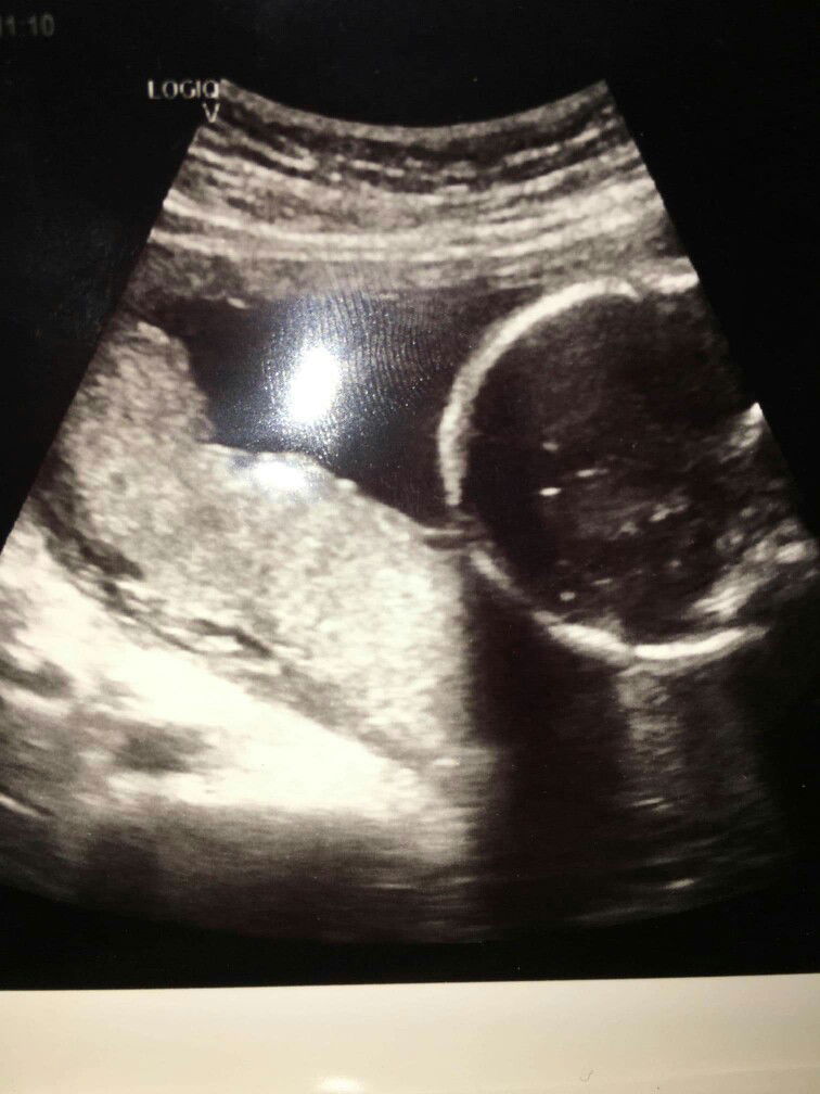 อัตราซาวมายังไม่รู้เลยเพศหญิงหรือชาย