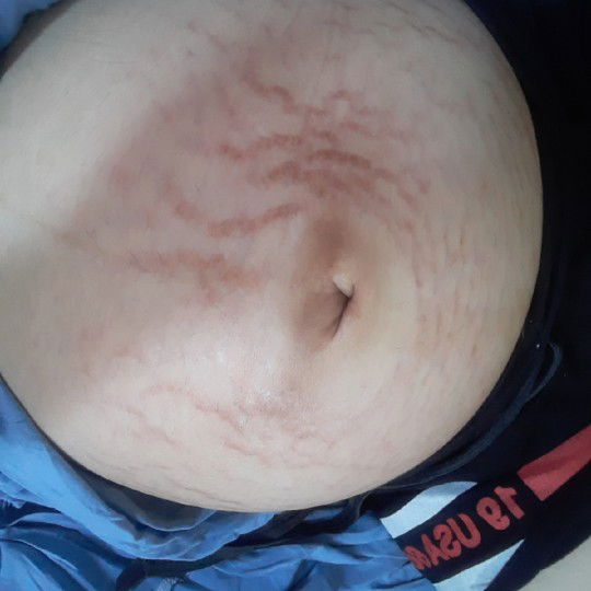 ช่วยแนะนำครีมสำหรับท้องแตกลายหน่อยคะ