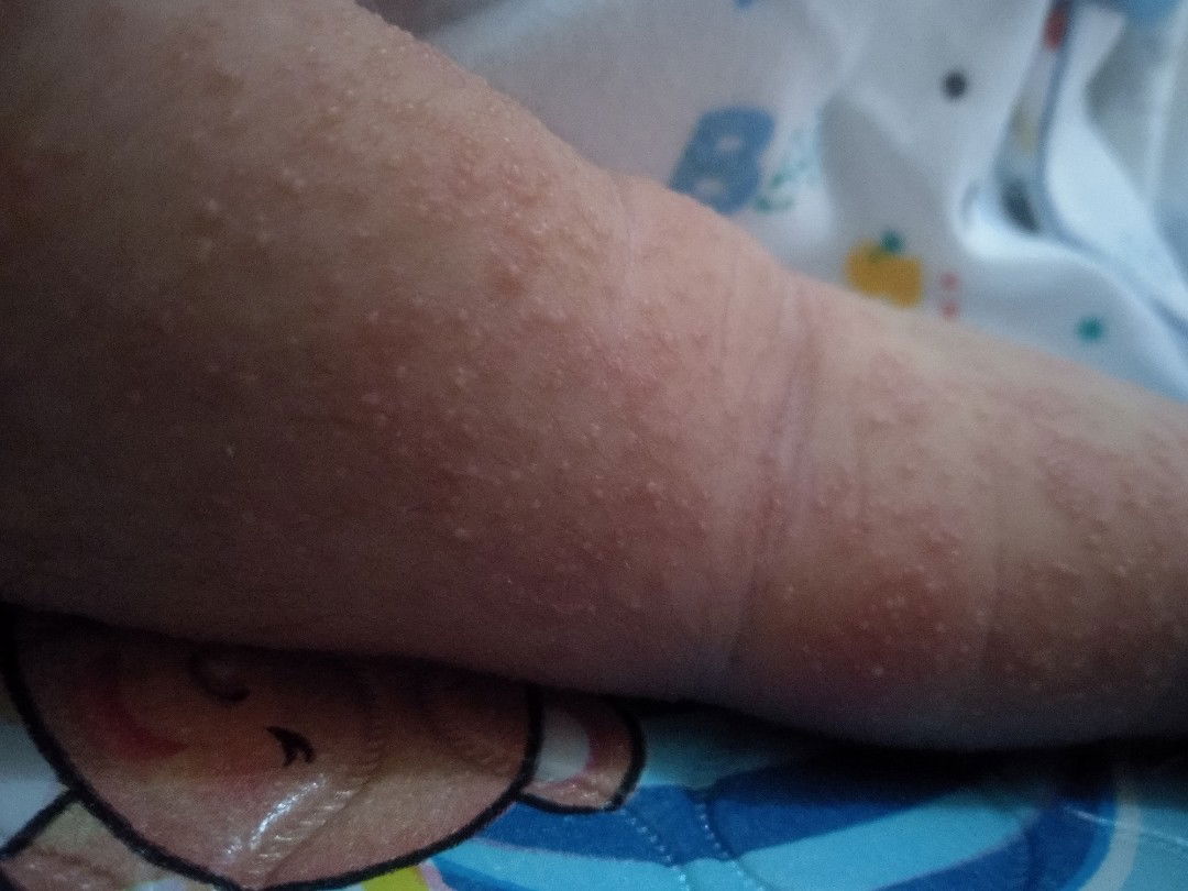 bintik merah dikulit