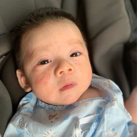 ผื่นแดง