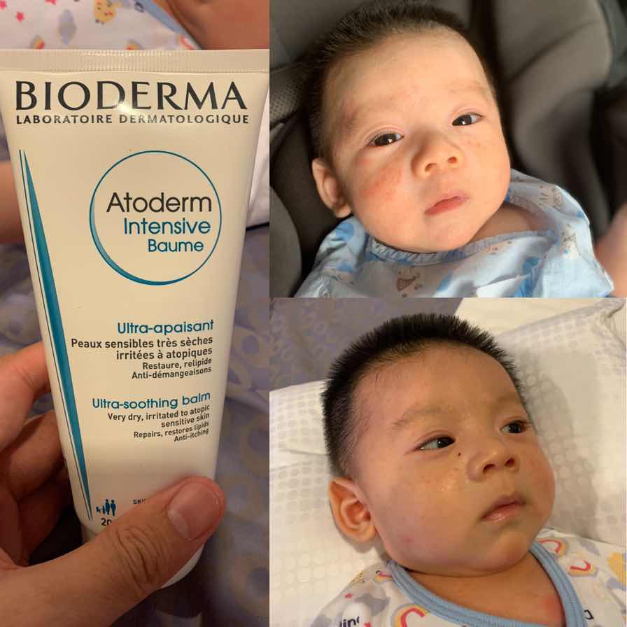 อัพเดตผื่นแดง