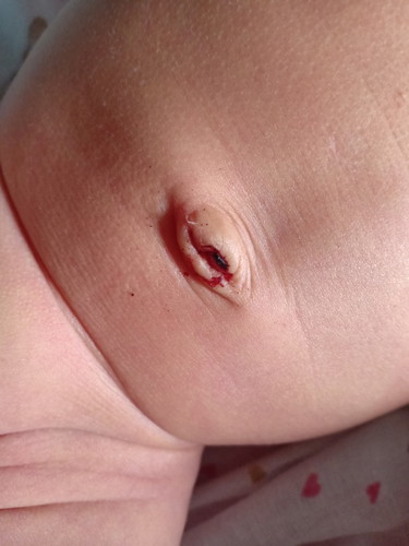 สายสะดือหลุดแต่มีเลือดซึม