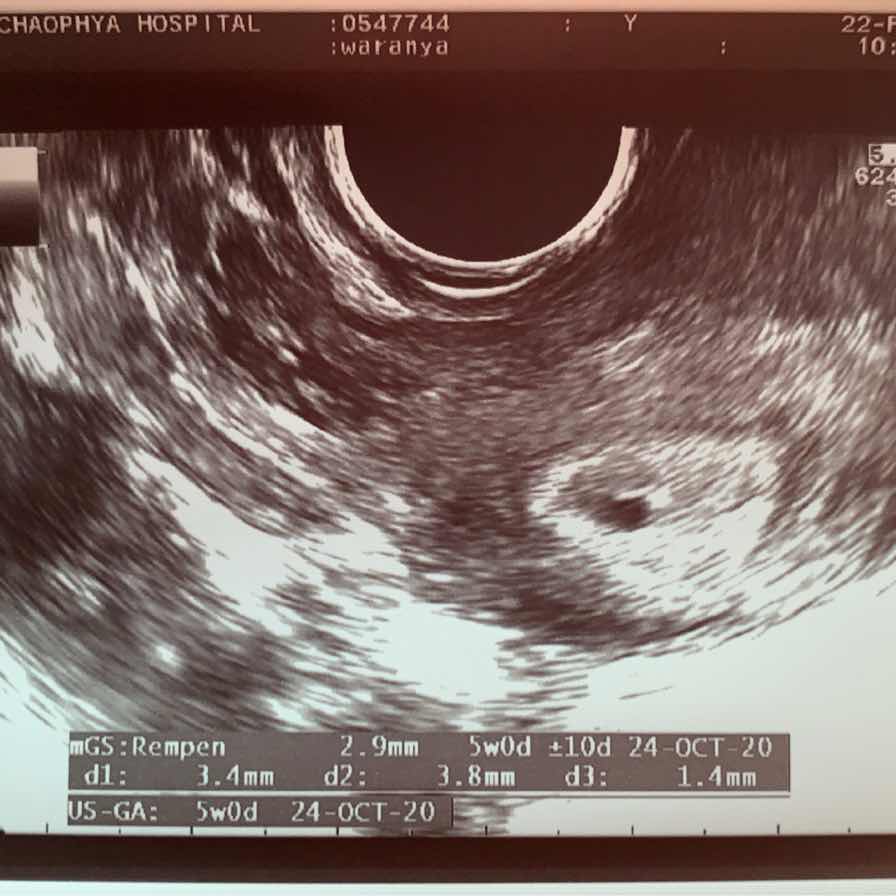 ภาพแรกของการตั้งครรภ์แรก