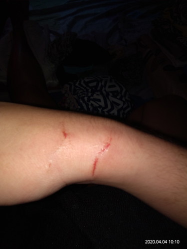 cat bite