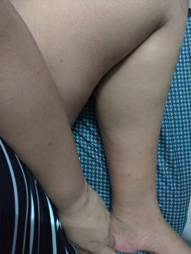 Skin Rashes at 28 weeks