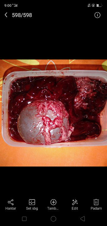 Keguguran kandungan 10 weeks