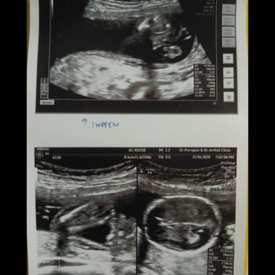 ดูยังไงว่าได้เพศชาย