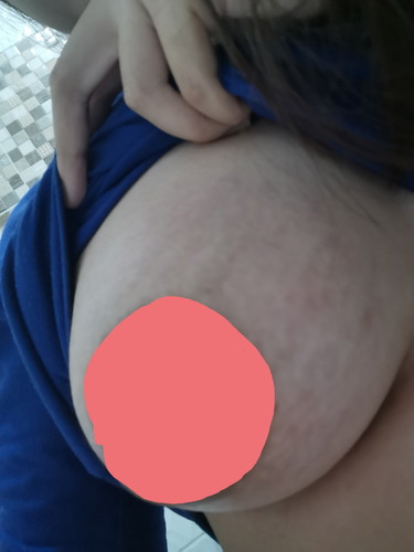 Stretch Marks Sa Boobs ?
