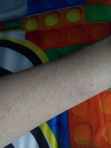 alergi atau bawaan bayi